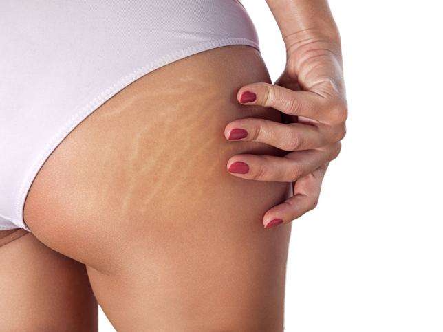 Striation Active Stretch Mark Cream 7.5% SNaP Complex